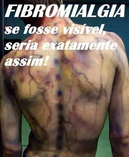 Fibromialgia, a doença invisível